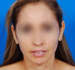 Woman's face, before Ear Surgery (Otoplasty) treatment, front view, patient 15