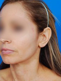 Woman's face, after Ear Surgery (Otoplasty) treatment, l-side oblique view, patient 15