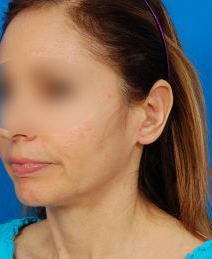 Woman's face, before Ear Surgery (Otoplasty) treatment, l-side oblique view, patient 15