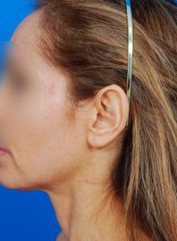 Woman's face, after Ear Surgery (Otoplasty) treatment, l-side view, patient 15