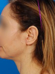 Woman's face, before Ear Surgery (Otoplasty) treatment, l-side view, patient 15