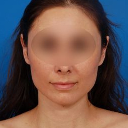 Woman's face, after Ear Surgery (Otoplasty) treatment, front view of head, patient 16