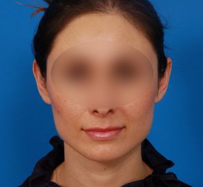 Woman's face, before Ear Surgery (Otoplasty) treatment, front view of head, patient 16