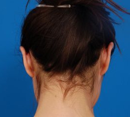 Woman's face, after Ear Surgery (Otoplasty) treatment, back side view of head, patient 16