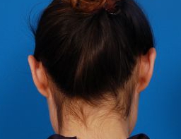 Woman's face, before Ear Surgery (Otoplasty) treatment, back side view of head, patient 16