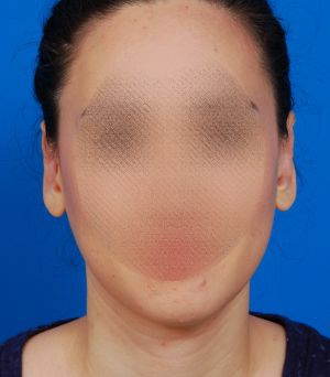 Woman's head, after Ear Surgery (Otoplasty) treatment, front view, patient 3