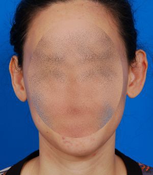 Woman's head, before Ear Surgery (Otoplasty) treatment, front view, patient 3