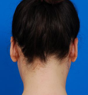 Woman's head, after Ear Surgery (Otoplasty) treatment, back side view, patient 3