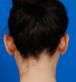Woman's head, before Ear Surgery (Otoplasty) treatment, back side view, patient 3