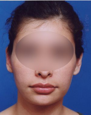 Woman's face, after Ear Surgery (Otoplasty) treatment, front view, patient 4