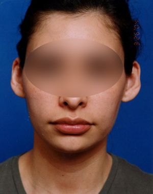 Woman's face, before Ear Surgery (Otoplasty) treatment, front view, patient 4