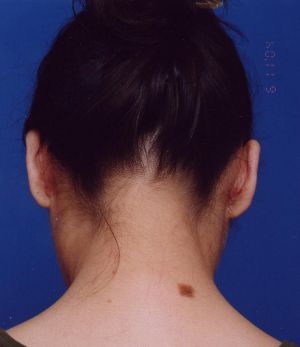 Woman's face, after Ear Surgery (Otoplasty) treatment, back side view, patient 4