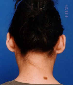 Woman's face, before Ear Surgery (Otoplasty) treatment, back side view, patient 4