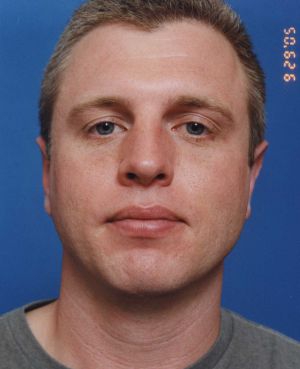 Male face, after Ear Surgery (Otoplasty) treatment, front view, patient 5
