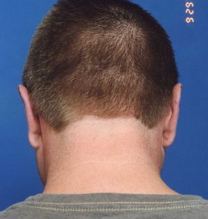 Male face, after Ear Surgery (Otoplasty) treatment, back side view, patient 5