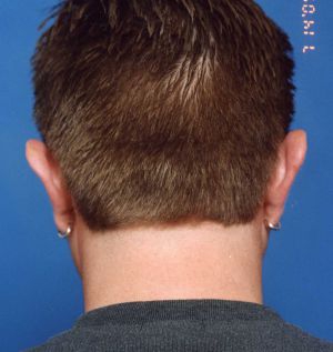 Male face, before Ear Surgery (Otoplasty) treatment, back side view, patient 5