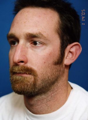 Male face, before Ear Surgery (Otoplasty) treatment, l-side oblique view of head, patient 6