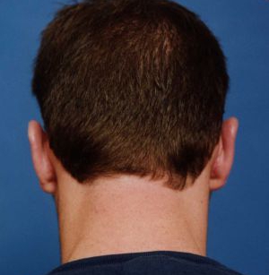 Male face, after Ear Surgery (Otoplasty) treatment, back side view of head, patient 6