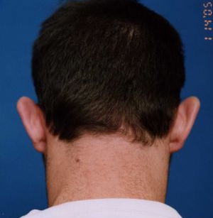 Male face, before Ear Surgery (Otoplasty) treatment, back side view of head, patient 6