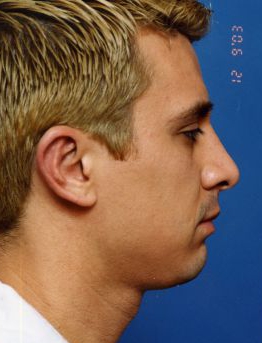 Male face, after Ear Surgery (Otoplasty) treatment, r-side view of head, patient 7