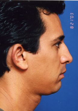 Male face, before Ear Surgery (Otoplasty) treatment, r-side view of head, patient 7