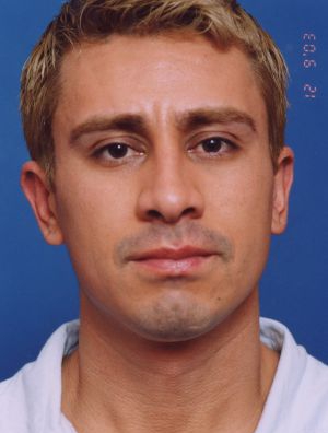 Male face, after Ear Surgery (Otoplasty) treatment, front view of head, patient 7