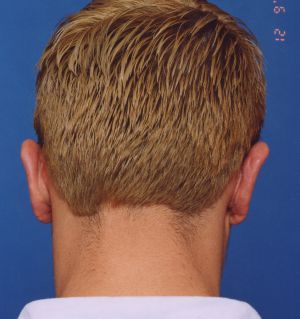 Male face, after Ear Surgery (Otoplasty) treatment, back side view of head, patient 7