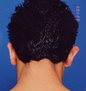Male face, before Ear Surgery (Otoplasty) treatment, back side view of head, patient 7