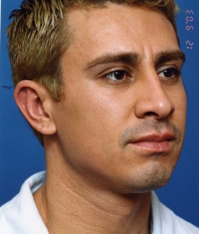 Male face, after Ear Surgery (Otoplasty) treatment, r-side oblique view of head, patient 7