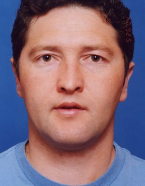 Male face, after Ear Surgery (Otoplasty) treatment, front view, patient 8