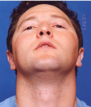 Male face, after Ear Surgery (Otoplasty) treatment, front view (bend over), patient 8