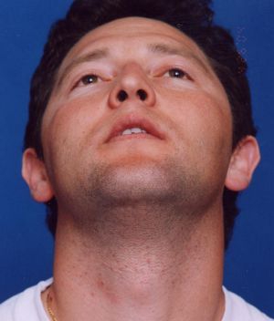 Male face, before Ear Surgery (Otoplasty) treatment, front view (bend over), patient 8