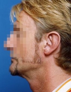 Male face, after Ear Surgery (Otoplasty) treatment, l-side view of head, patient 1