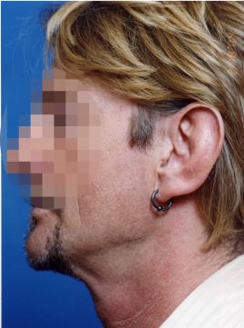 Male face, before Ear Surgery (Otoplasty) treatment, l-side view of head, patient 1