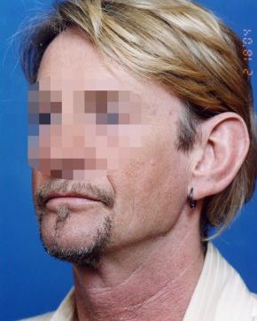 Male face, before Ear Surgery (Otoplasty) treatment, l-side oblique view of head, patient 1