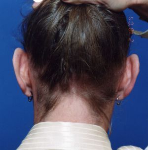 Male face, before Ear Surgery (Otoplasty) treatment, back side view of head, patient 1