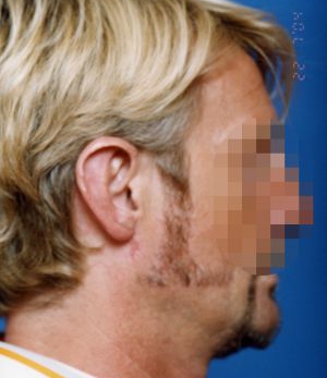 Male face, after Ear Surgery (Otoplasty) treatment, r-side view of head, patient 1