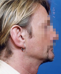 Male face, before Ear Surgery (Otoplasty) treatment, r-side view of head, patient 1