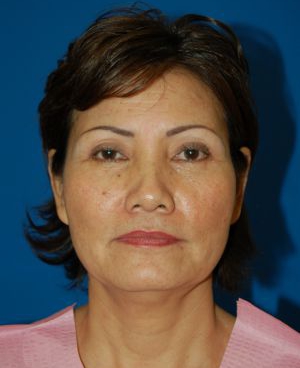 Woman's face, before Brow Lift, Forehead Lift treatment, front view, patient 7