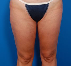 Female body, after Liposuction Revision treatment, front view, patient 2