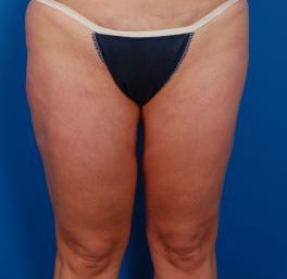 Female body, before Liposuction Revision treatment, front view, patient 2