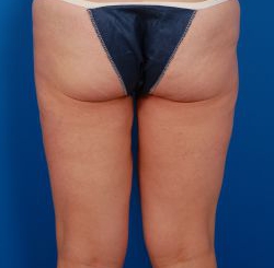 Female body, before Liposuction Revision treatment, back view, patient 2