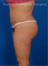 Woman's body, after C-Section Scar Removal treatment, l-side view, patient 2