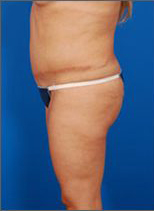 Woman's body, before C-Section Scar Removal treatment, l-side view, patient 2