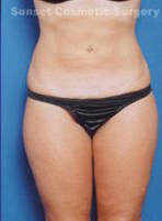 Woman's body, after C-Section Scar Removal treatment, front view, patient 1