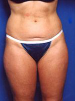 Woman's body, before C-Section Scar Removal treatment, front view, patient 1