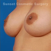 Woman's breasts, after Nipple Reduction treatment, l-side oblique view, patient 2