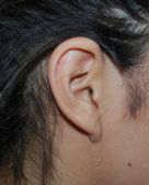 Female ear, after Otoplasty - Ear Lesion treatment, r-side view, patient 2