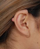 Female ear, before Otoplasty - Ear Lesion treatment, r-side view, patient 2