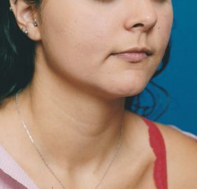Woman's face, after Submental Lipocontouring treatment, r-side oblique view, patient 10